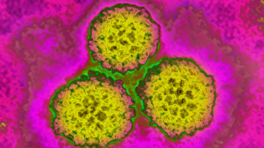 is-there-really-a-new-outbreak-of-hpv-that-kills-faster-than-aids